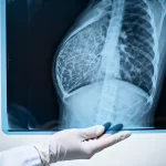 New guidelines for breast cancer screening: Screening should begin at age 40